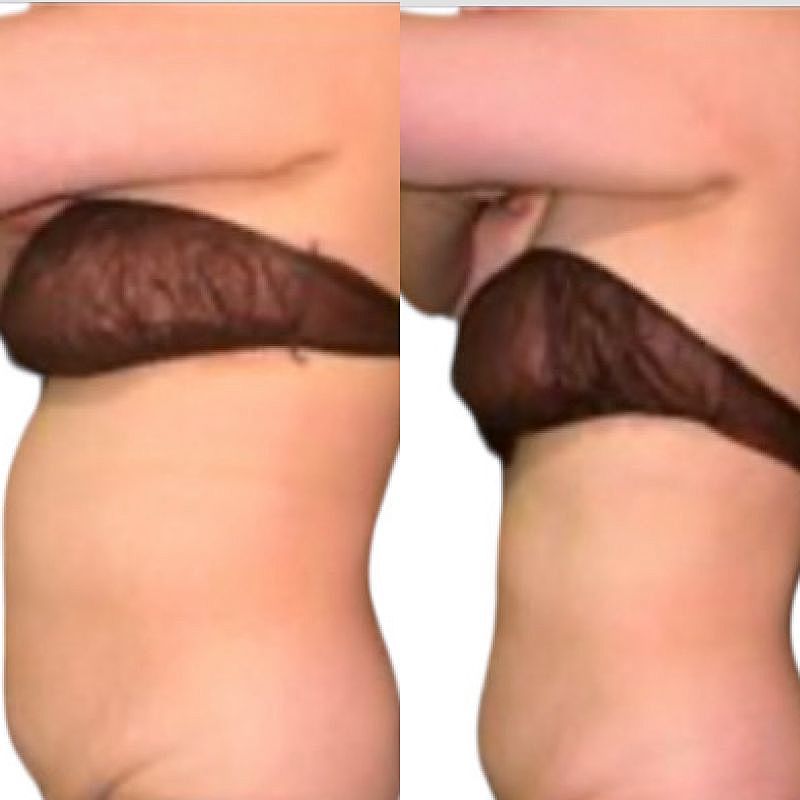 ブライダル全身美白&全身結果出し痩身プラン１２回券　150分コース