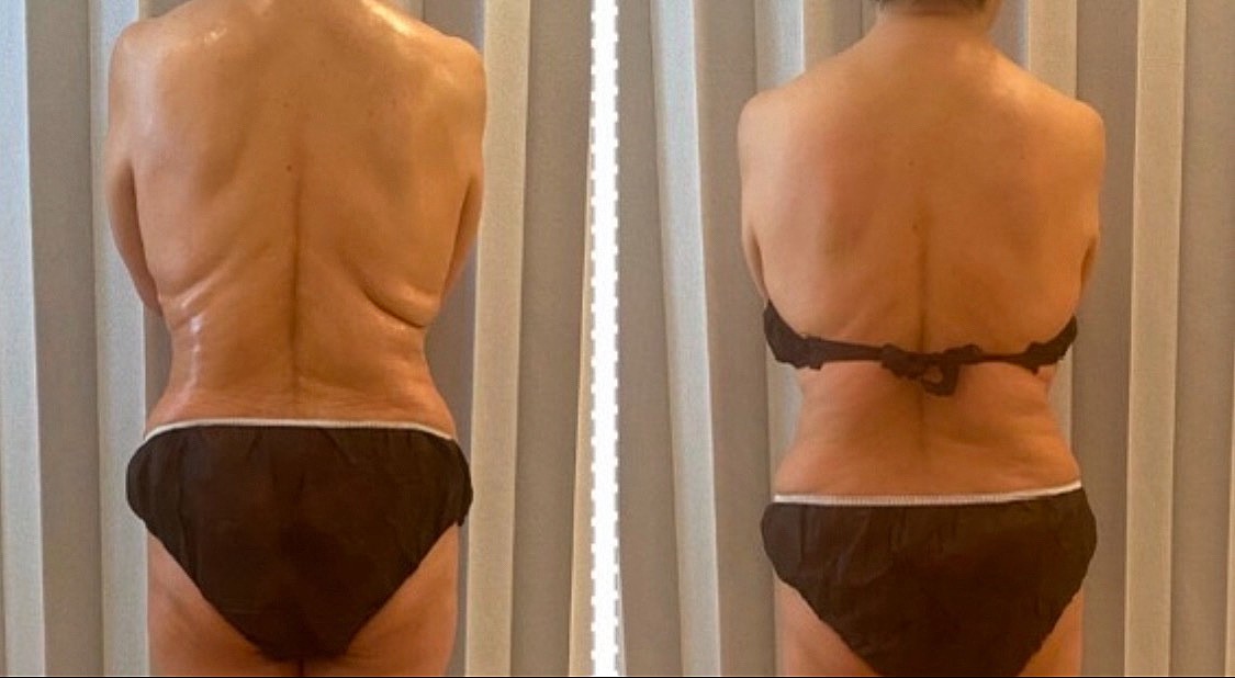 ブライダル背面の贅肉撃退＆美Sライン強化プラン３回券　150分コース