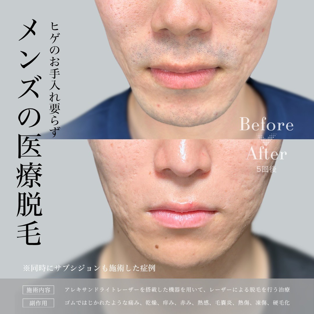 【新郎限定】痛くない医療脱毛 ひげ1回(コースも可)